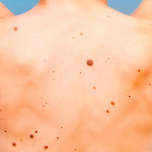 skin cancer clinic Maroochydore